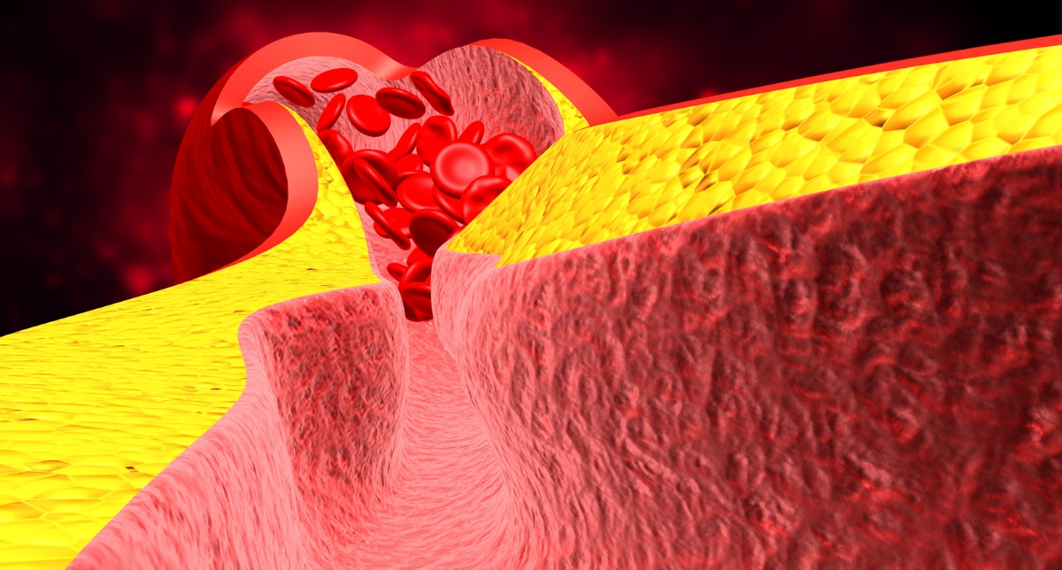 Heart Block – What are they 