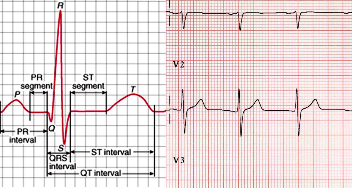 ECG Wave Interpretation: A Complete Guide to Understanding Heart Activity